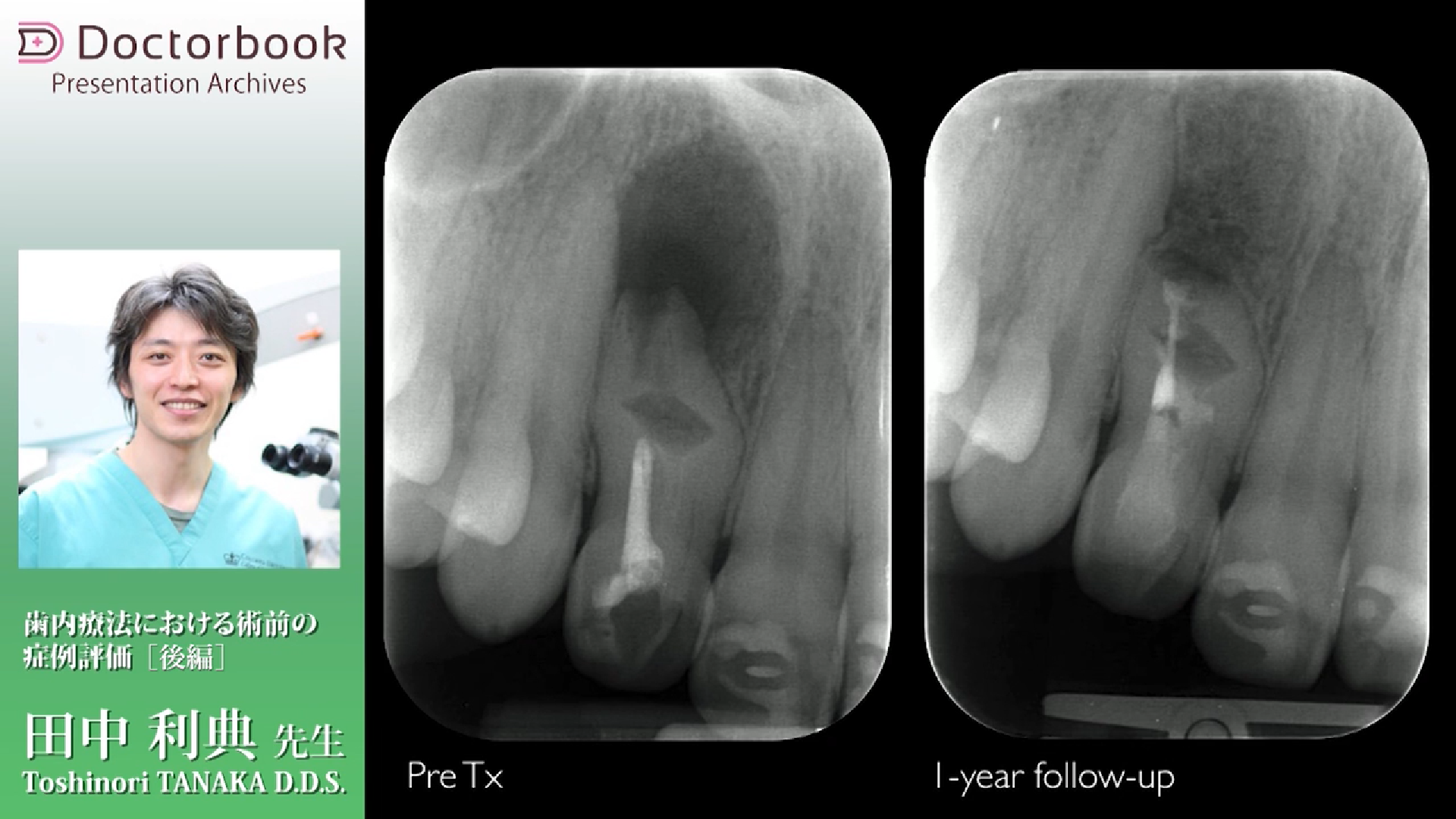 写真とエビデンスで歯種別に学ぶ! 歯内療法に生かす根管解剖 CBCT